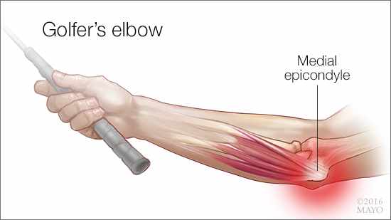 Image result for picture of golfers elbow