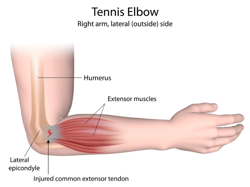 Image result for picture of tennis elbow