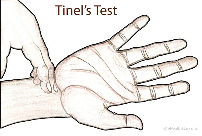 Ulnar Nerve Entrapment at the Wrist - Dr. Groh