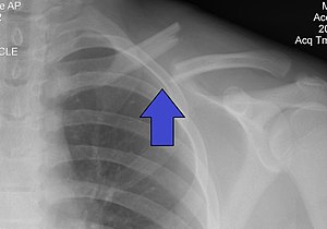 Image result for xray of clavicle fracture