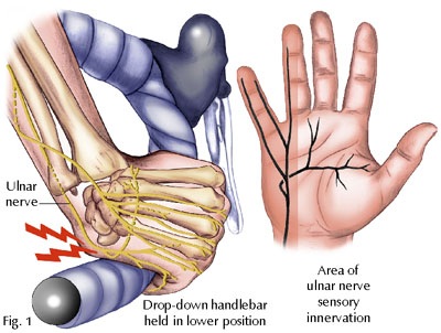 Ulnar nerve entrapment