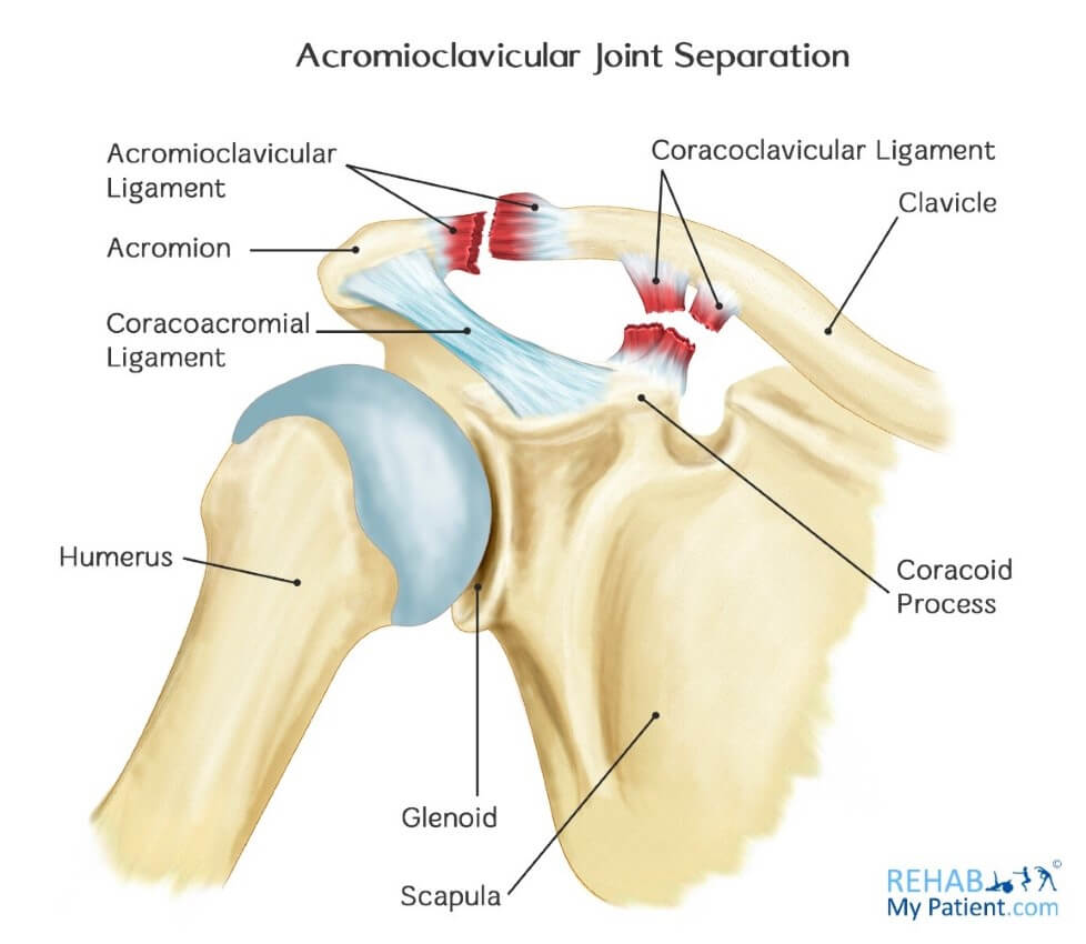 Image result for diagram for ac joint separation