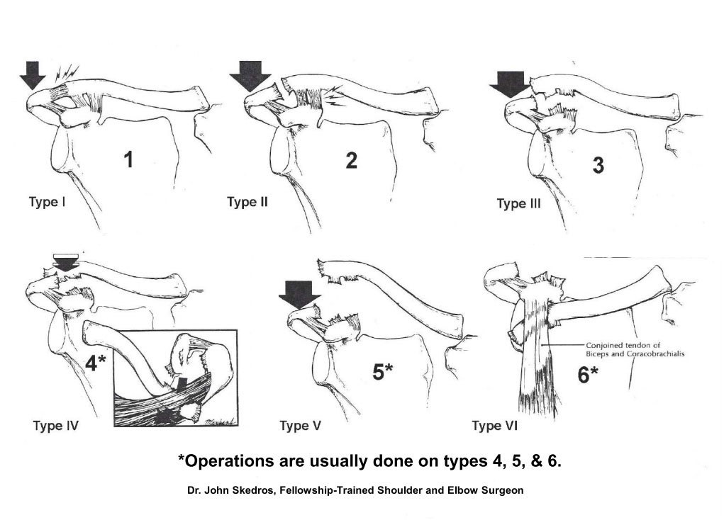 Image result for diagram for ac joint separation