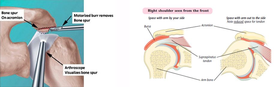 Image result for drawing for shoulder subacromial decompression