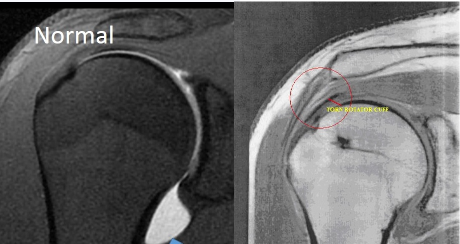 Image result for mri of shoulder with rotator cuff tendonitis