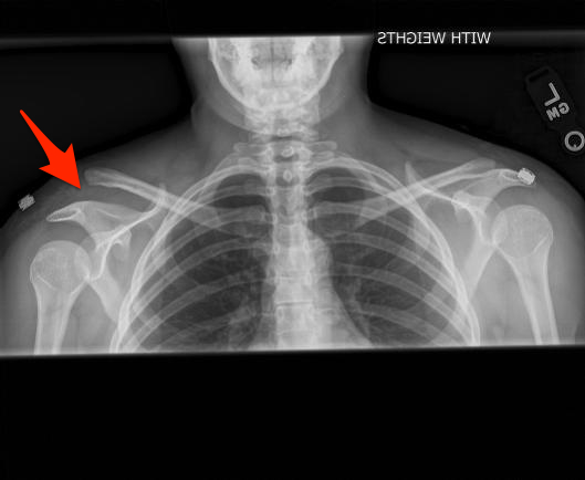 Image result for x ray of shoulder separation