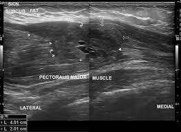 Understanding Pectoral Strains or a Rupture: Causes & Treatment - JOI  Jacksonville Orthopaedic Institute