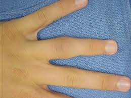 Sprained Finger, Finger Sprain
